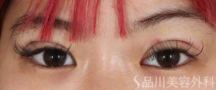 症例NO.72362のAFTER写真