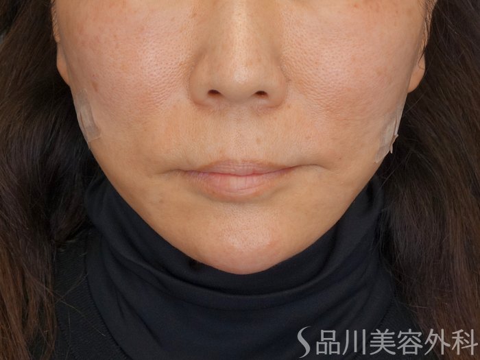 症例NO.72893のAFTER写真