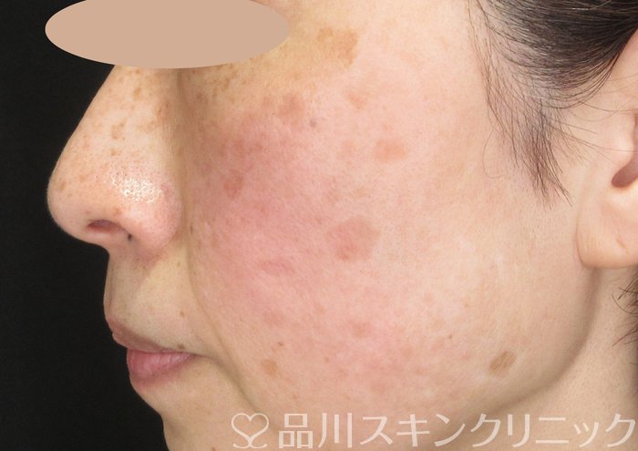 症例NO.73794のBEFORE写真