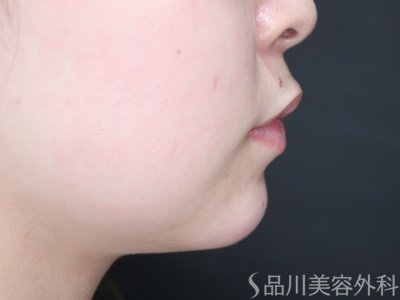 症例NO.69966のAFTER写真