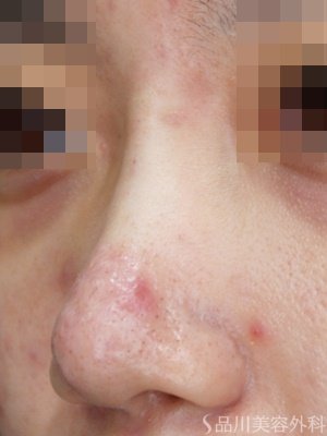 症例NO.71639のAFTER写真