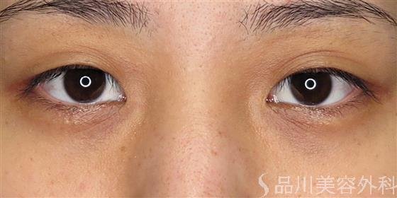 症例NO.56185のBEFORE写真