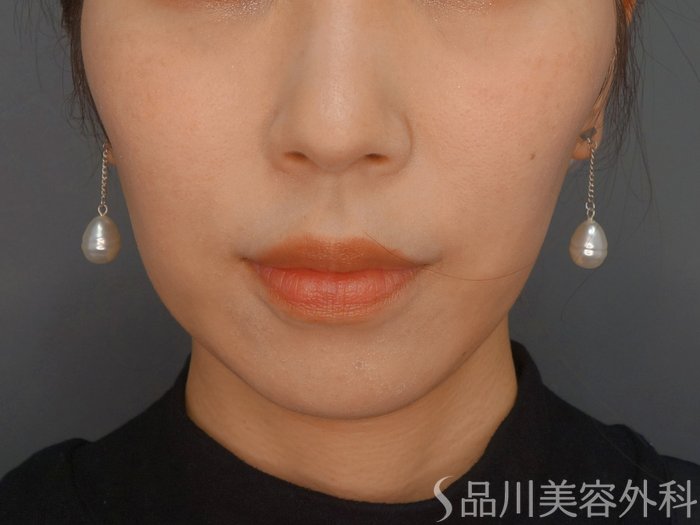 症例NO.73900のBEFORE写真
