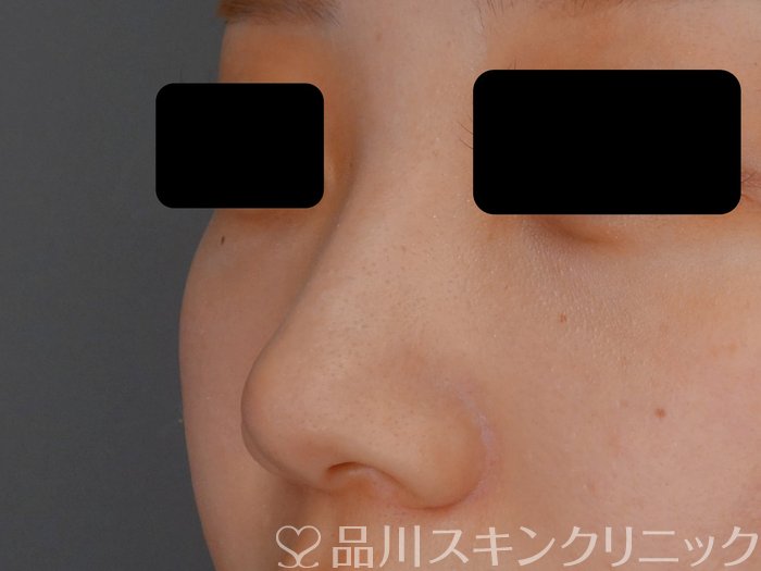 症例NO.70949のBEFORE写真