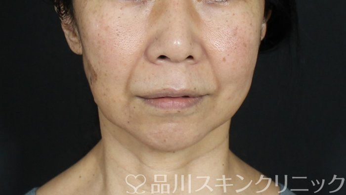 症例NO.72403のBEFORE写真