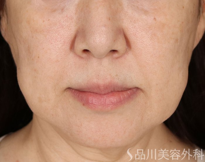 症例NO.71349のBEFORE写真