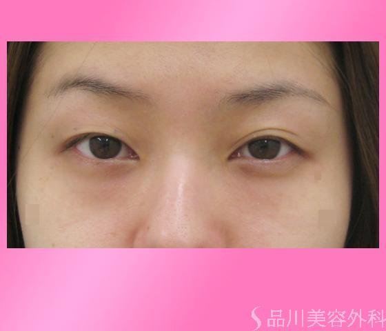 症例NO.2939のBEFORE写真