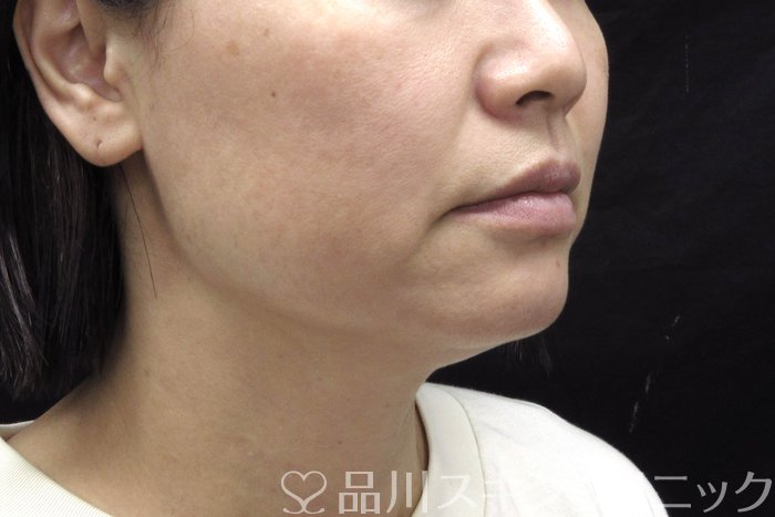 症例NO.74448のBEFORE写真