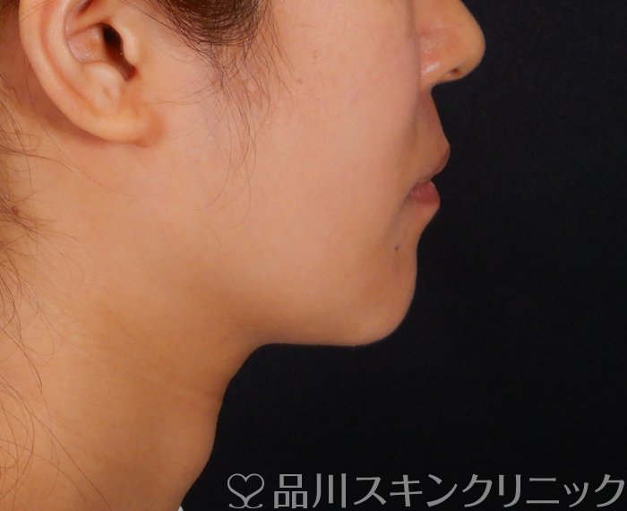 症例NO.65842のAFTER写真