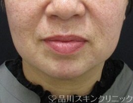 症例NO.69884のAFTER写真