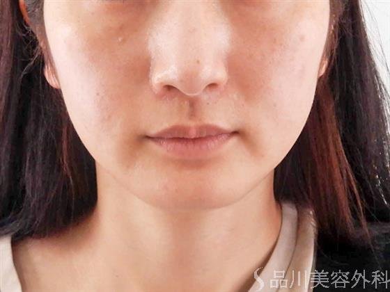症例NO.60940のBEFORE写真