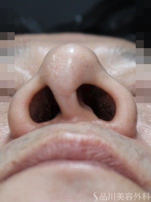 症例NO.69333のBEFORE写真