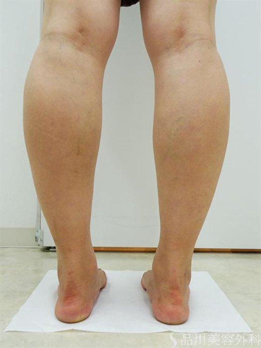 症例NO.44170のBEFORE写真