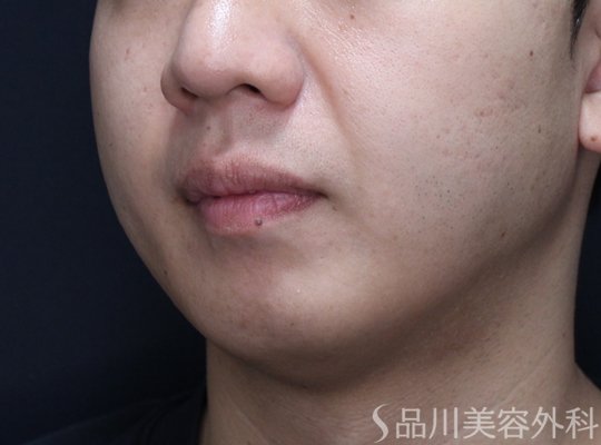 症例NO.72147のAFTER写真