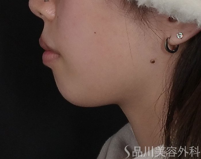 症例NO.69442のBEFORE写真