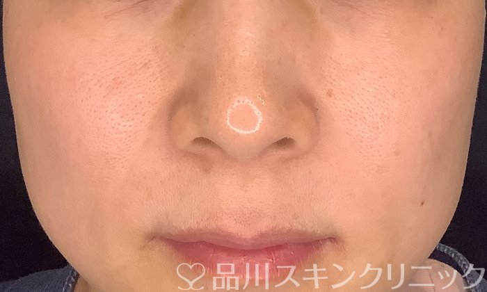 症例NO.73718のAFTER写真