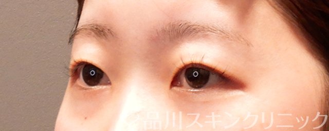 症例NO.69366のBEFORE写真