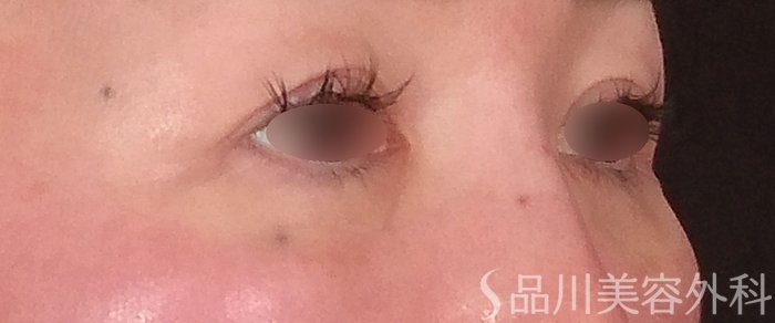 症例NO.69983のAFTER写真