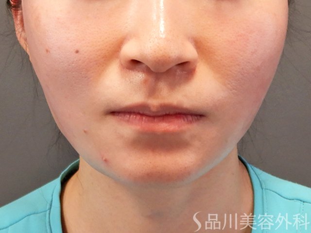 症例NO.70315のAFTER写真