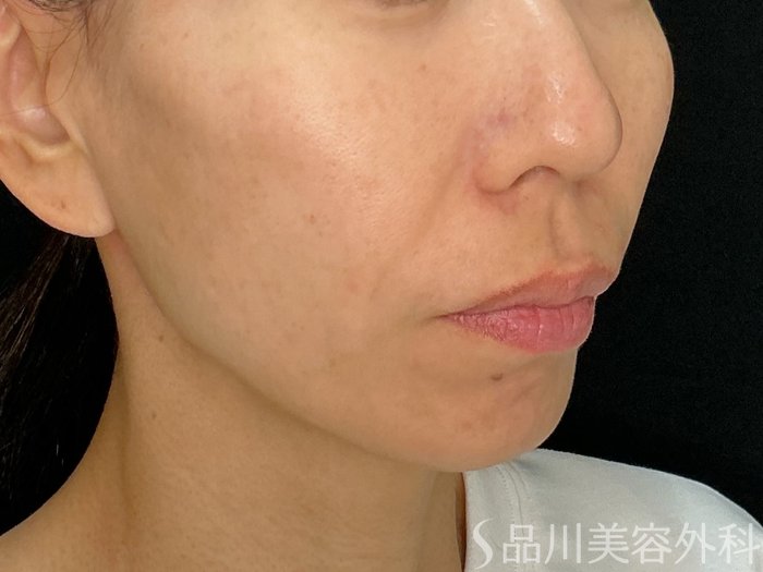 症例NO.72733のBEFORE写真