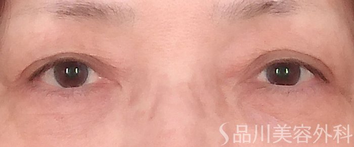 症例NO.70533のBEFORE写真
