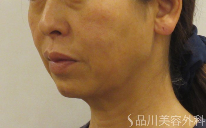 症例NO.71805のBEFORE写真