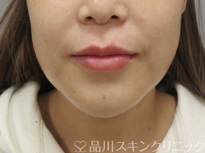 症例NO.73898のAFTER写真