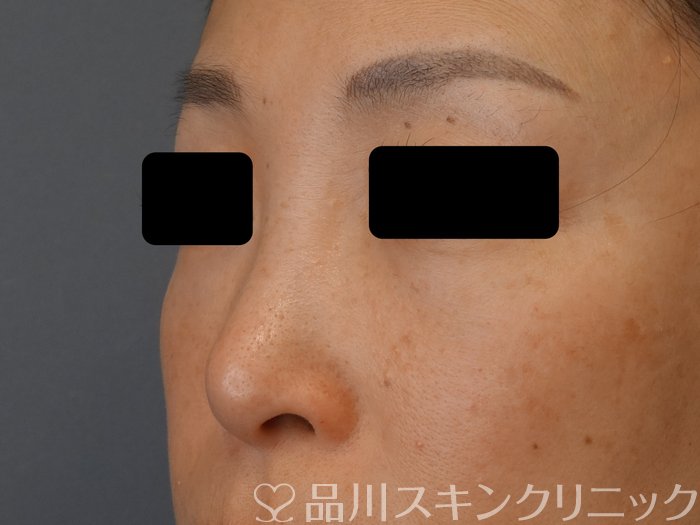 症例NO.74630のBEFORE写真