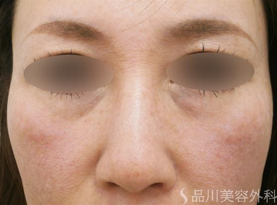 症例NO.15313のBEFORE写真
