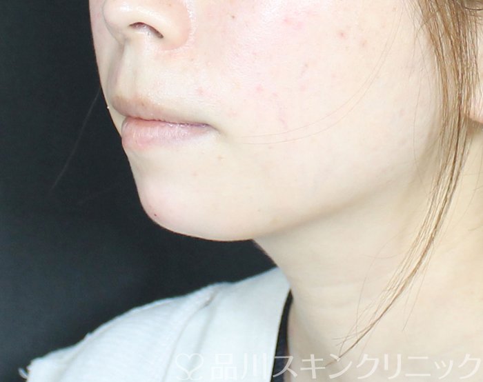 症例NO.69698のAFTER写真