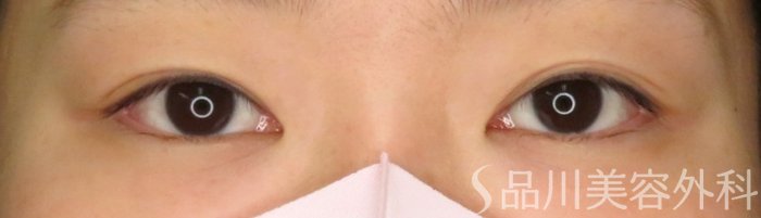 症例NO.65857のBEFORE写真
