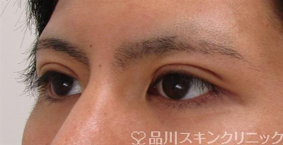 症例NO.42339のAFTER写真