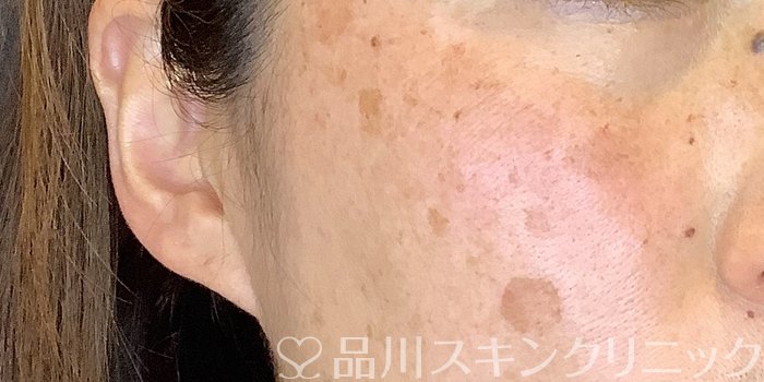 症例NO.70186のBEFORE写真