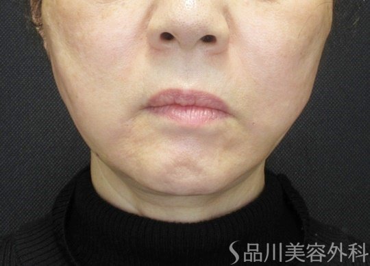 症例NO.69058のAFTER写真