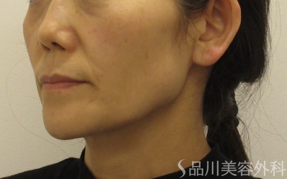 症例NO.72707のAFTER写真