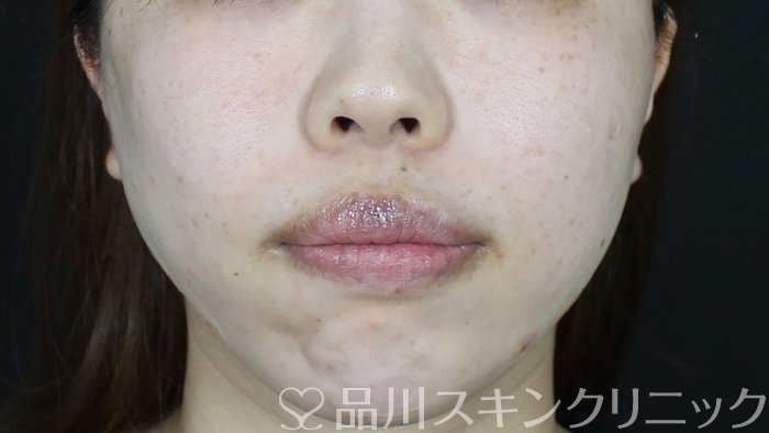 症例NO.71269のAFTER写真