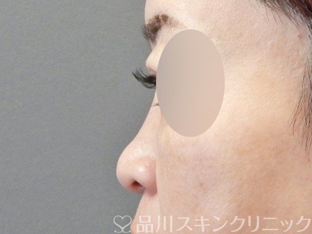 症例NO.66774のBEFORE写真