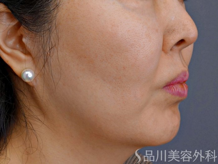 症例NO.74089のBEFORE写真