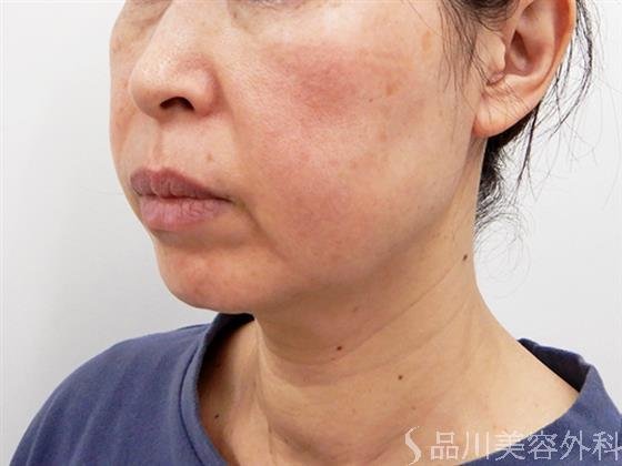 症例NO.53454のBEFORE写真