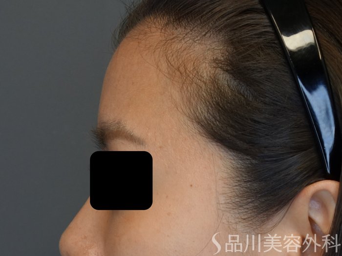 症例NO.74041のBEFORE写真