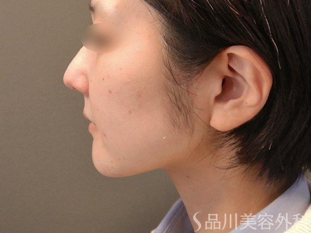症例NO.65570のAFTER写真