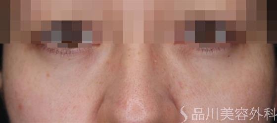 症例NO.59672のBEFORE写真