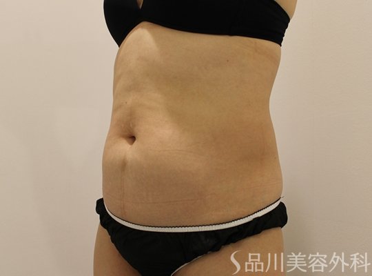 症例NO.71694のBEFORE写真