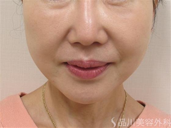 症例NO.39938のAFTER写真