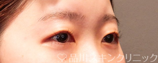 症例NO.69366のBEFORE写真