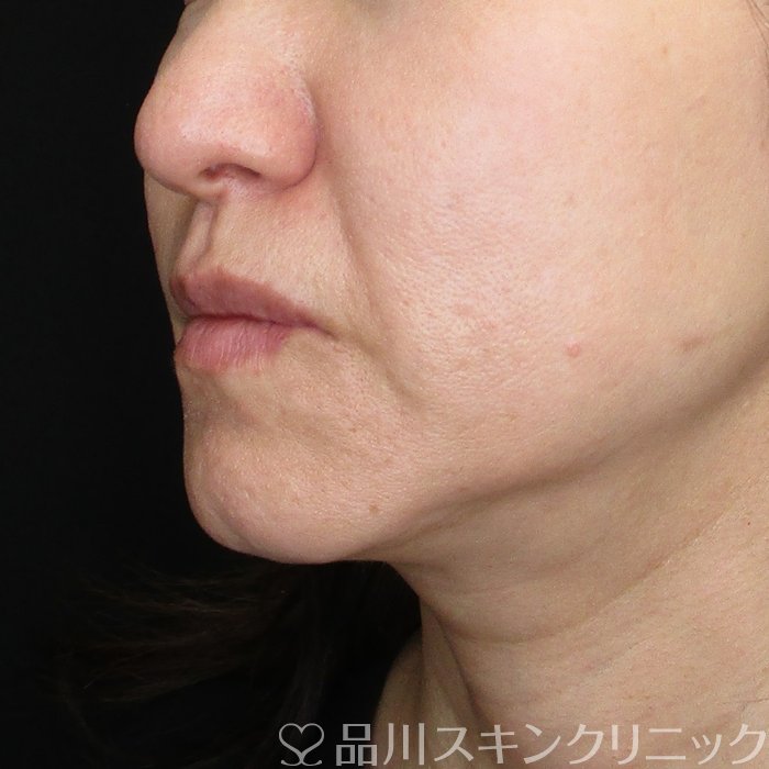症例NO.74723のBEFORE写真