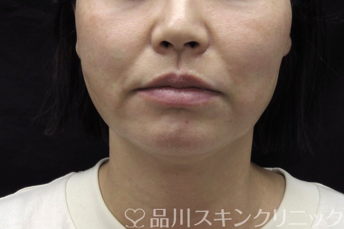 症例NO.74448のAFTER写真