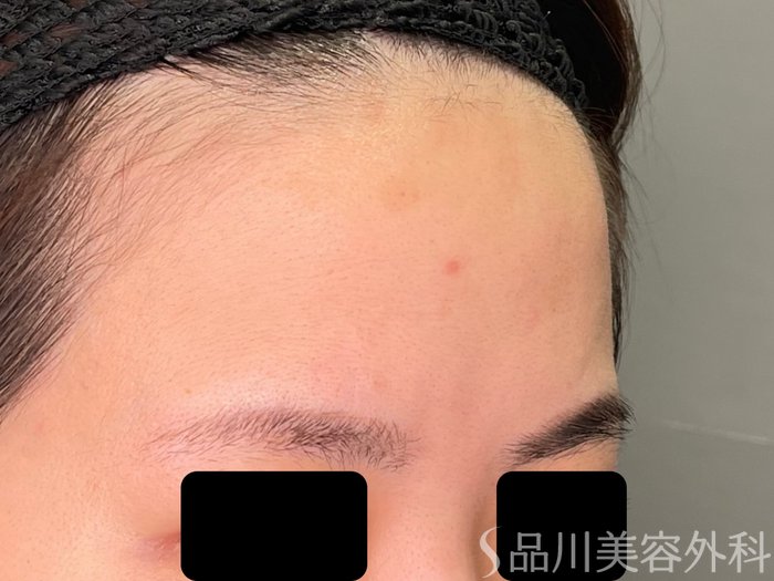 症例NO.71423のBEFORE写真