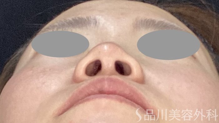 症例NO.70875のBEFORE写真
