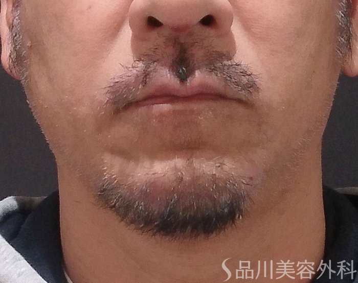 症例NO.69684のBEFORE写真